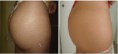 /album/estrias-antes-e-depois/maquiagem-definitiva-para-estrias1-jpg1/